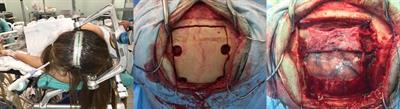 Contralateral Anterior Interhemispheric–Transcallosal–Transrostral Approach for the Resection of a Subcallosal Cavernous Malformation: A Case Report and an Operative Video